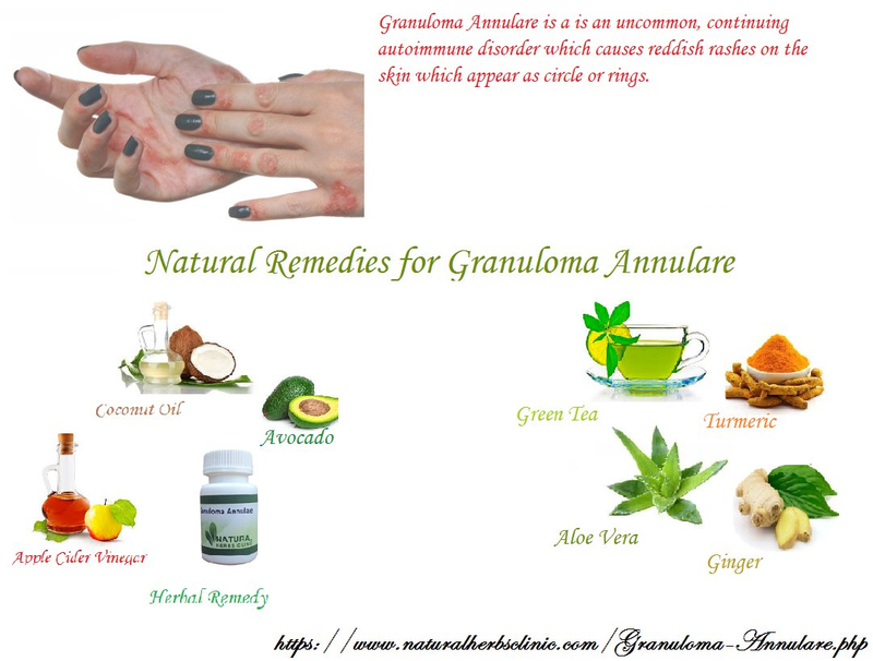 Illustration for article titled Granuloma Annulare and its Treatment with Natural and Herbal Remedies